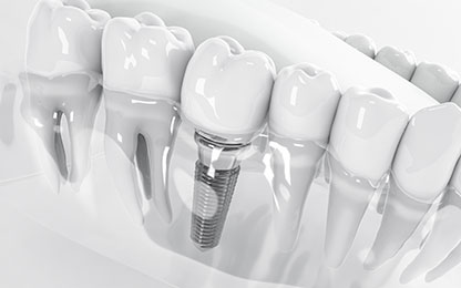 Dental Implants